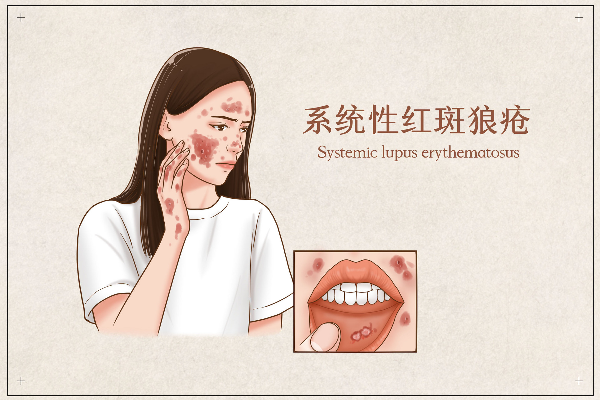 摄图网_401794490_banner_系统性红斑狼疮医疗插画（企业商用）.jpg